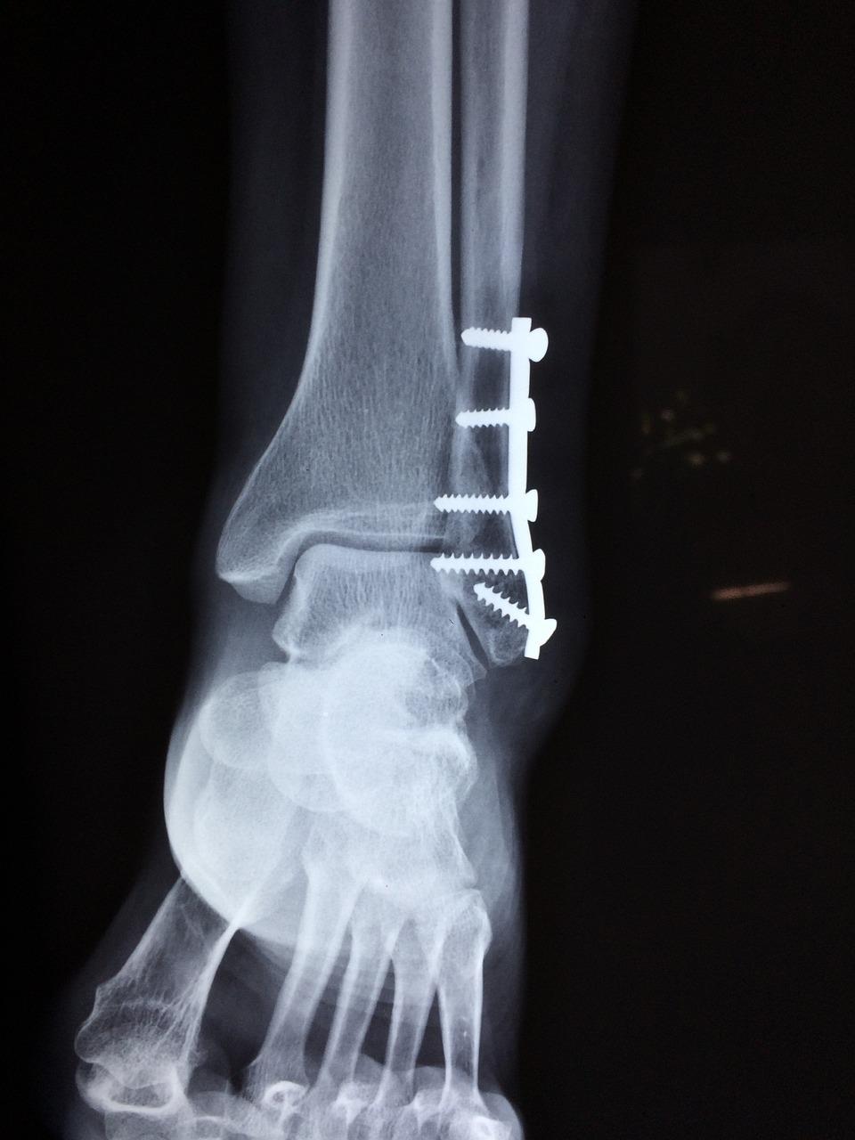 Orthopedie in Helmond
